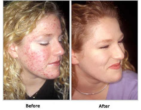 Benzoyl Peroxide Acne Treatment
