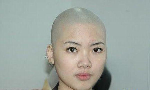 Bald asian women