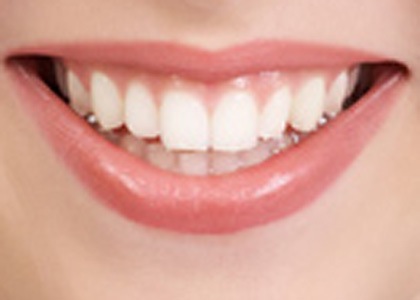 How to Keep Teeth White Naturally