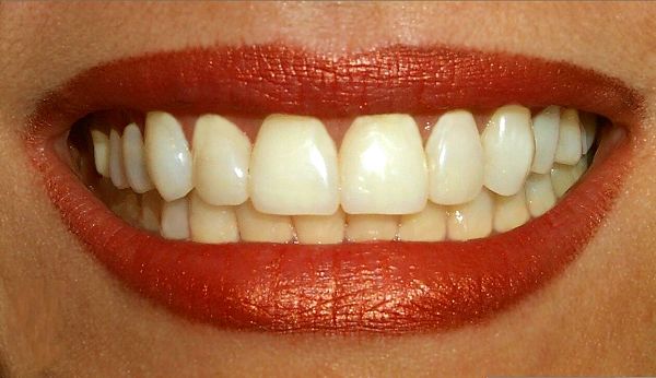 How to Keep Teeth White Naturally