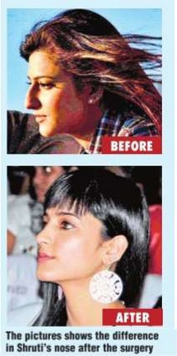 Shruti Hassan Before and After - XciteFun.net