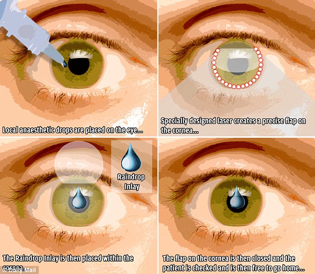 raindrop-implant-to-cure-eyesight-vision-problem-xcitefun